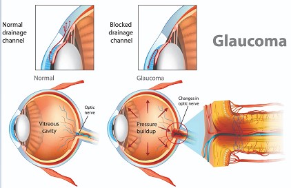 Glaucoma netra