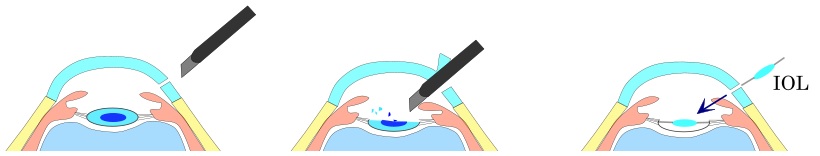 Phacoemulsification